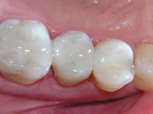 composite-filling-toronto-dentist