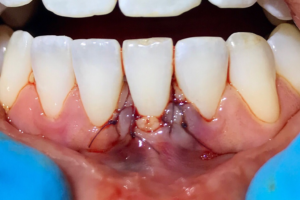 connective-tissue-graft