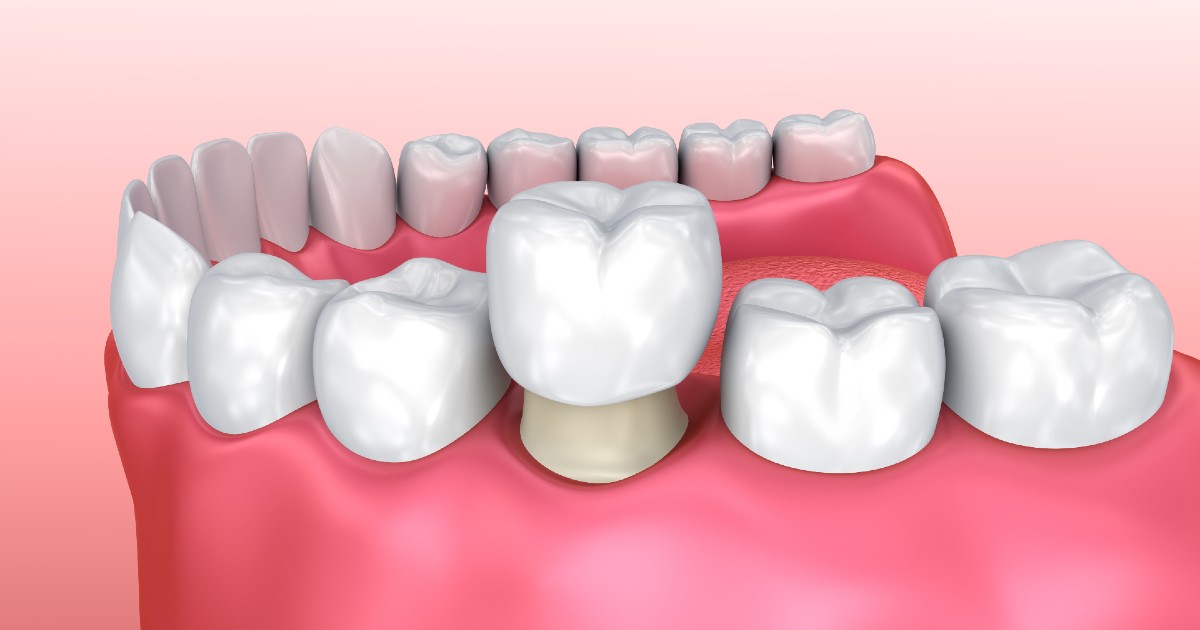 Dental Crown Recementation Atlas Dental, Toronto dentist