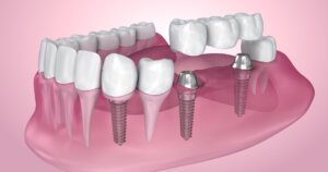 Dental implants Toronto dentist