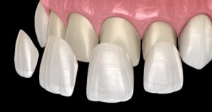 Dental veneers Toronto dentist