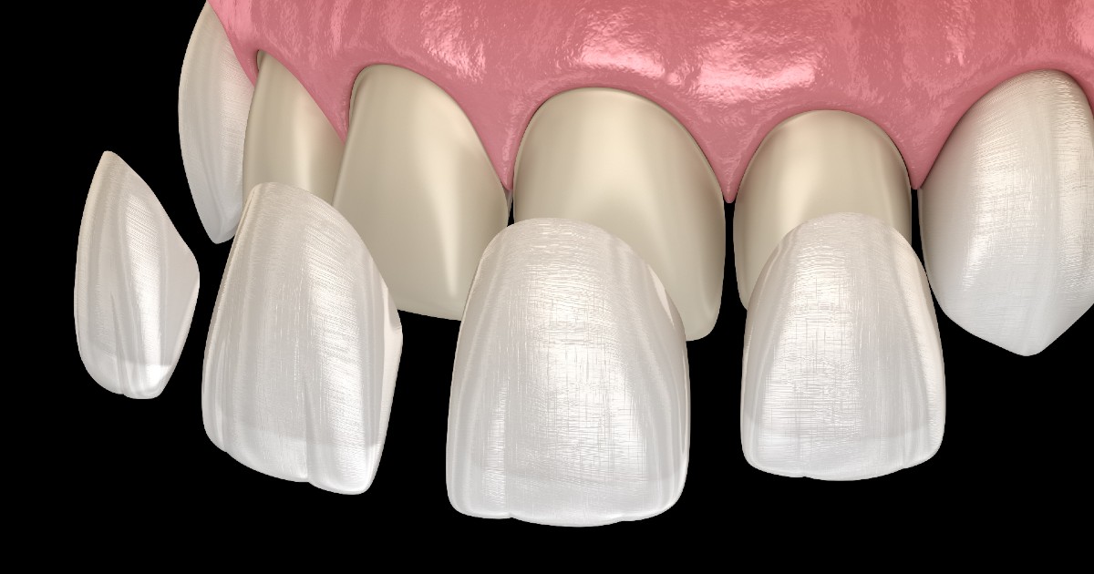 Does a Dental Veneer Treatment Damage Teeth? - Gables Exceptional