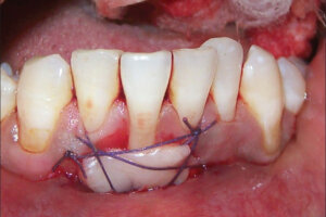 free-gingival-gum-graft