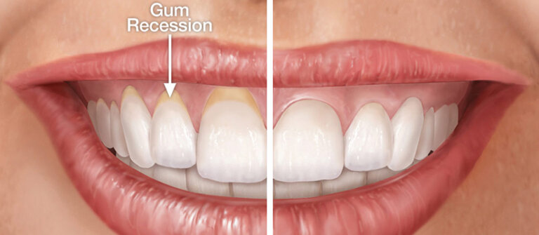 gum-graft-toronto-dentist-before-and-after