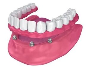 implant-dentures-toronto-dentist