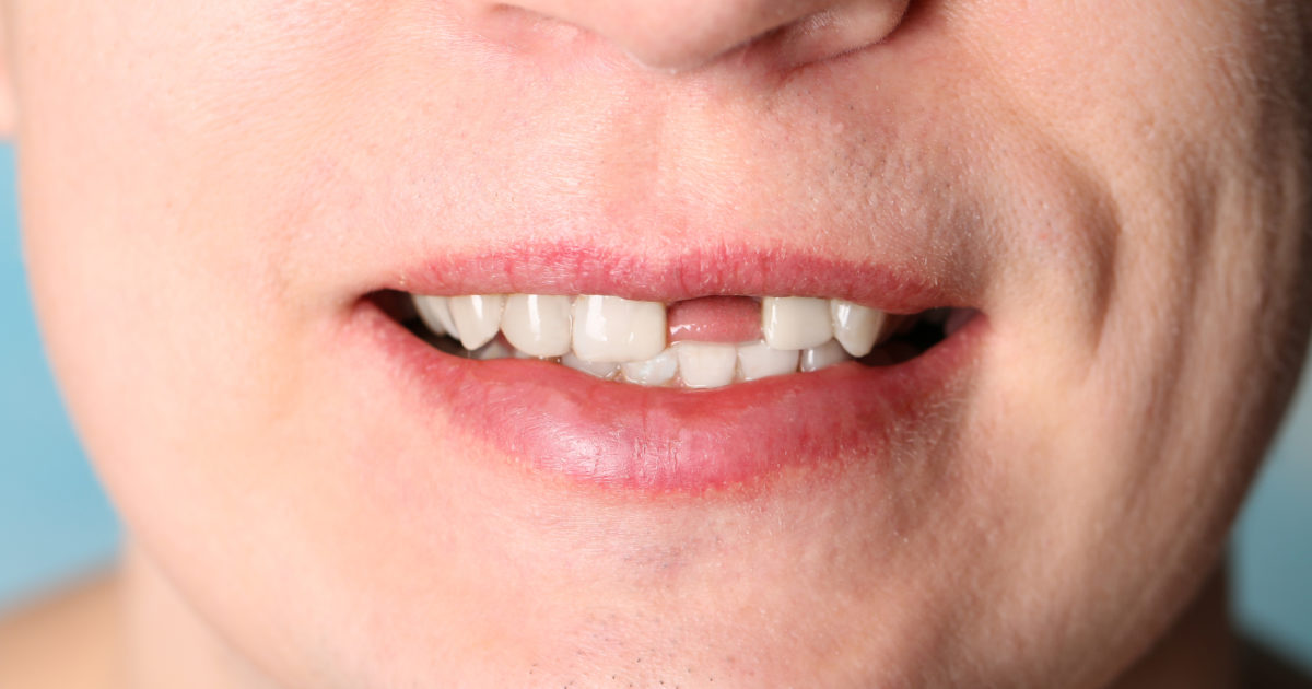 Knocked Out Tooth First Aid - Atlas Dental