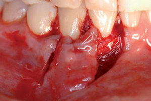 laterally-positioned-flap-graft