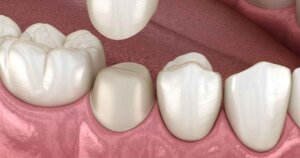 loose or missing dental crown, toronto dentist