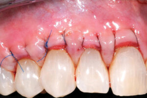 minimally-invasive-tunnel-gum-graft