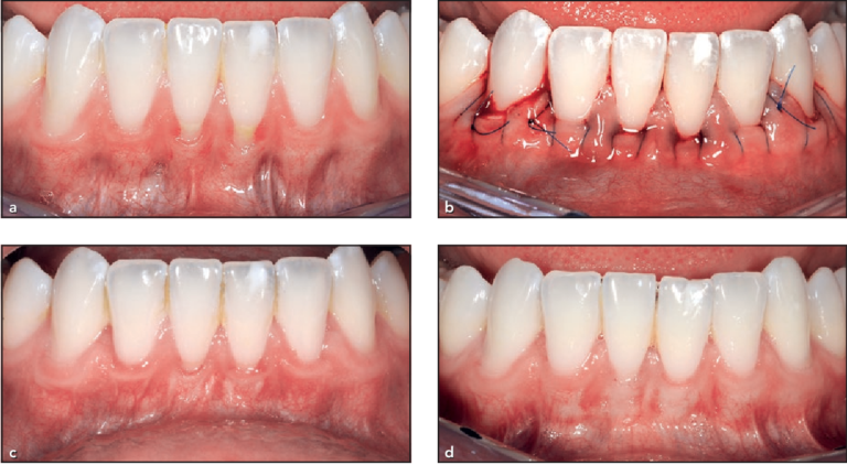 minimally -invasive-tunngel-gum-graft-2