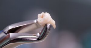 tooth removal toronto dentist