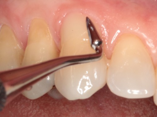 resin-modified-glass-ionomer-toronto-dentist