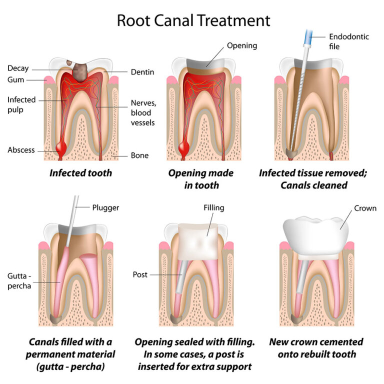 root-canal-treatment-procedure-toronto-dentist