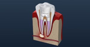 Root canal treatment Toronto Dentist