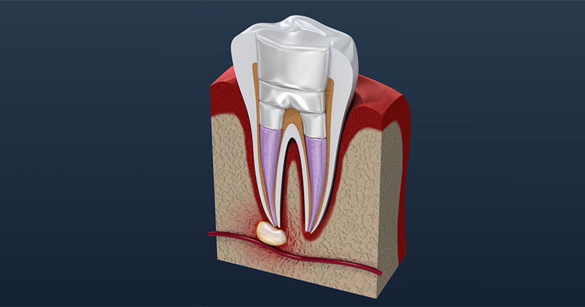 Root Canal Treatment PostOperative Instructions