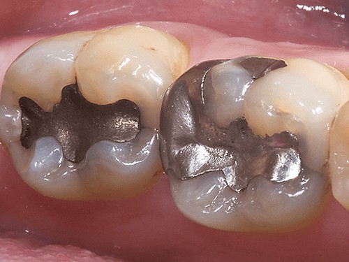 silver-amalgam-filling-toronto-dentist
