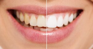 Teeth whitening Toronto dentist