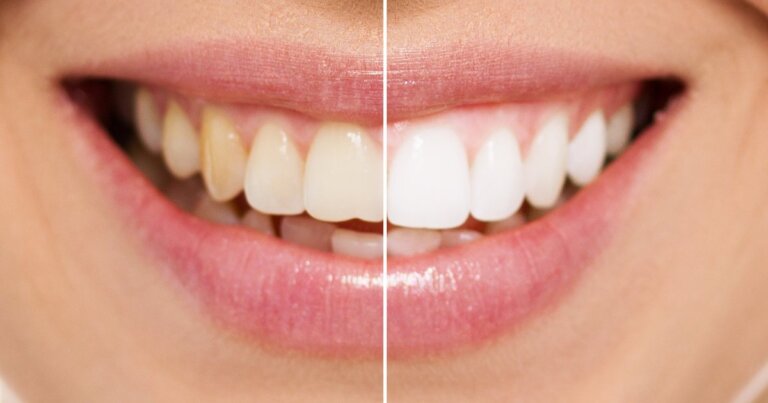 Teeth whitening Toronto dentist