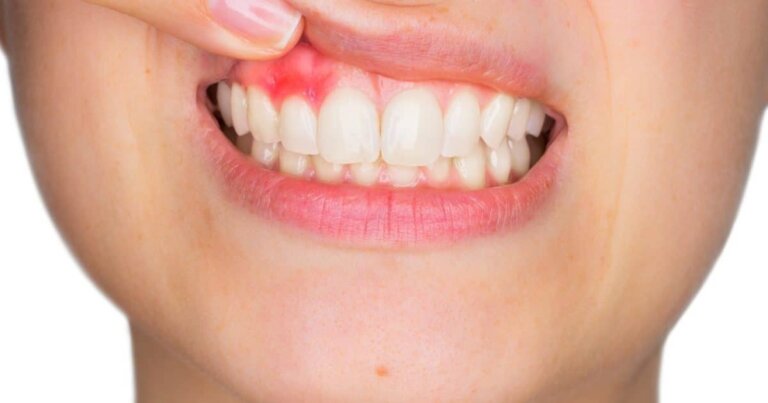 tooth abscess toronto dentist