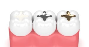 Tooth fillings Toronto dentist Atlas Dental