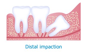 wisdom-teeth-impaction-distal