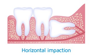 wisdom-teeth-impaction-horizontal