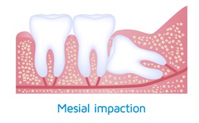 wisdom-teeth-impaction-mesial