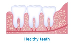 wisdom-teeth-impaction-normal