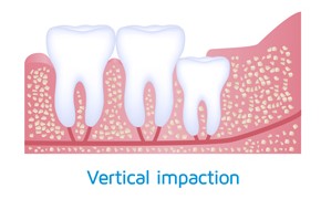 wisdom-teeth-impaction-vertical