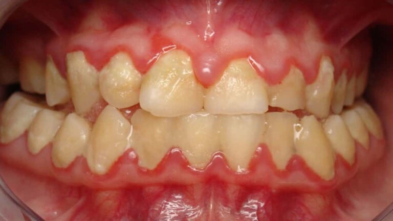 dental-plaque-toronto-dentist-near-me