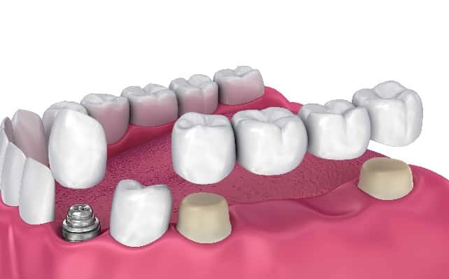 dental implant and dental bridge