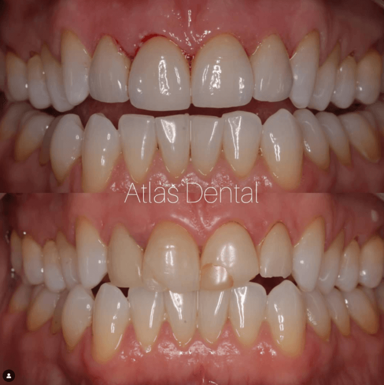 dental veneers toronto