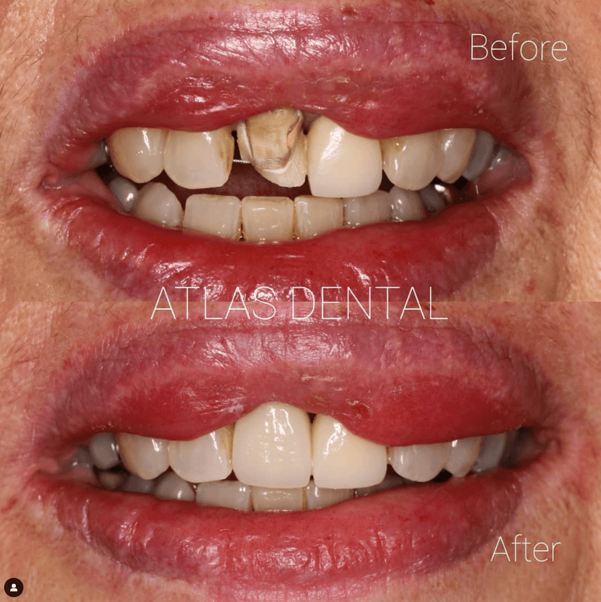 dental veneers toronto