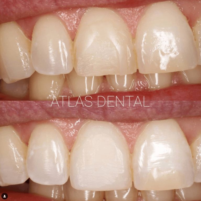 dental veneers toronto