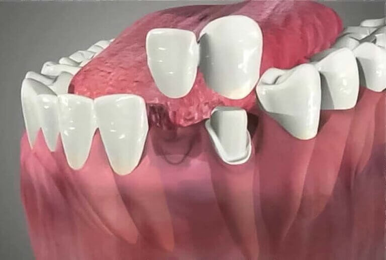 Cantilever dental bridge