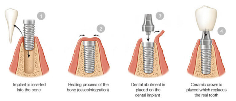 dental-implant-drill-sequence