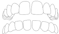 gapped teeth