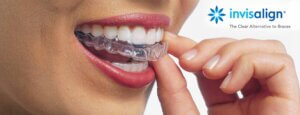 Invisalign Toronto