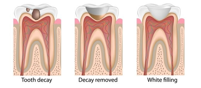 tooth filling procedure