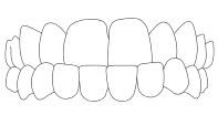 underbite