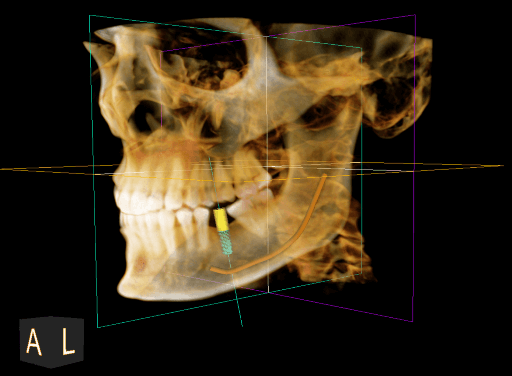 Bitewing X-Rays - Atlas Dental Toronto