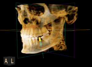 3D rendering of a CBCT scan of human skull