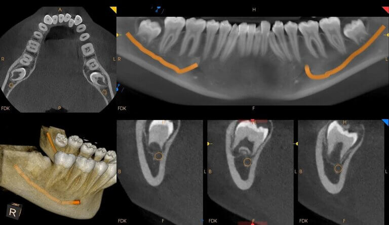 third molar CBCT scan cross sections