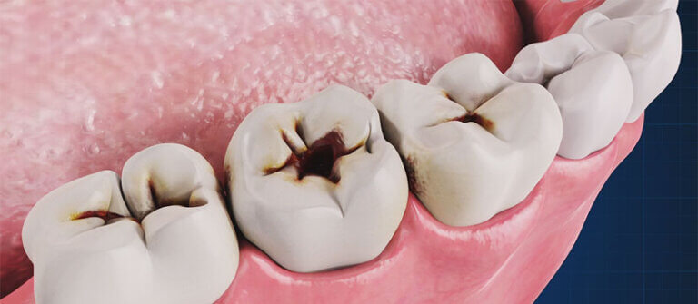Row of teeth with occlusal fit and fissure cavities