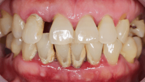 Intraoral photo showing teeth with gum disease and abundant plaque