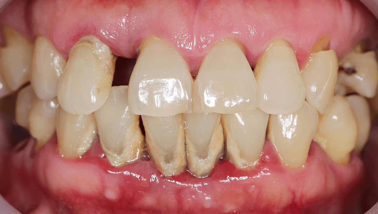 Tartar on Teeth (Dental Calculus): Causes & Removal