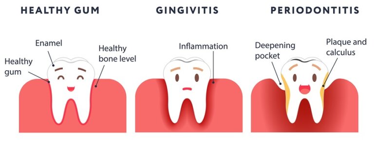 Progression of gum disease from healthy, to gingivitis, to periodontitis