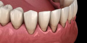 Mandibular row of teeth with gum disease and recession