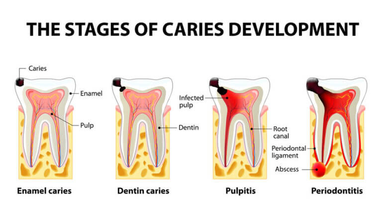Diagram showing stages of tooth decay, from enamel caries, to dentinal caries, pulpitis and dental abscess (periodontitis)