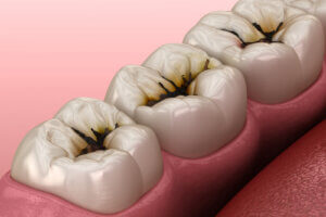 Row of three teeth with pit and fissure caries